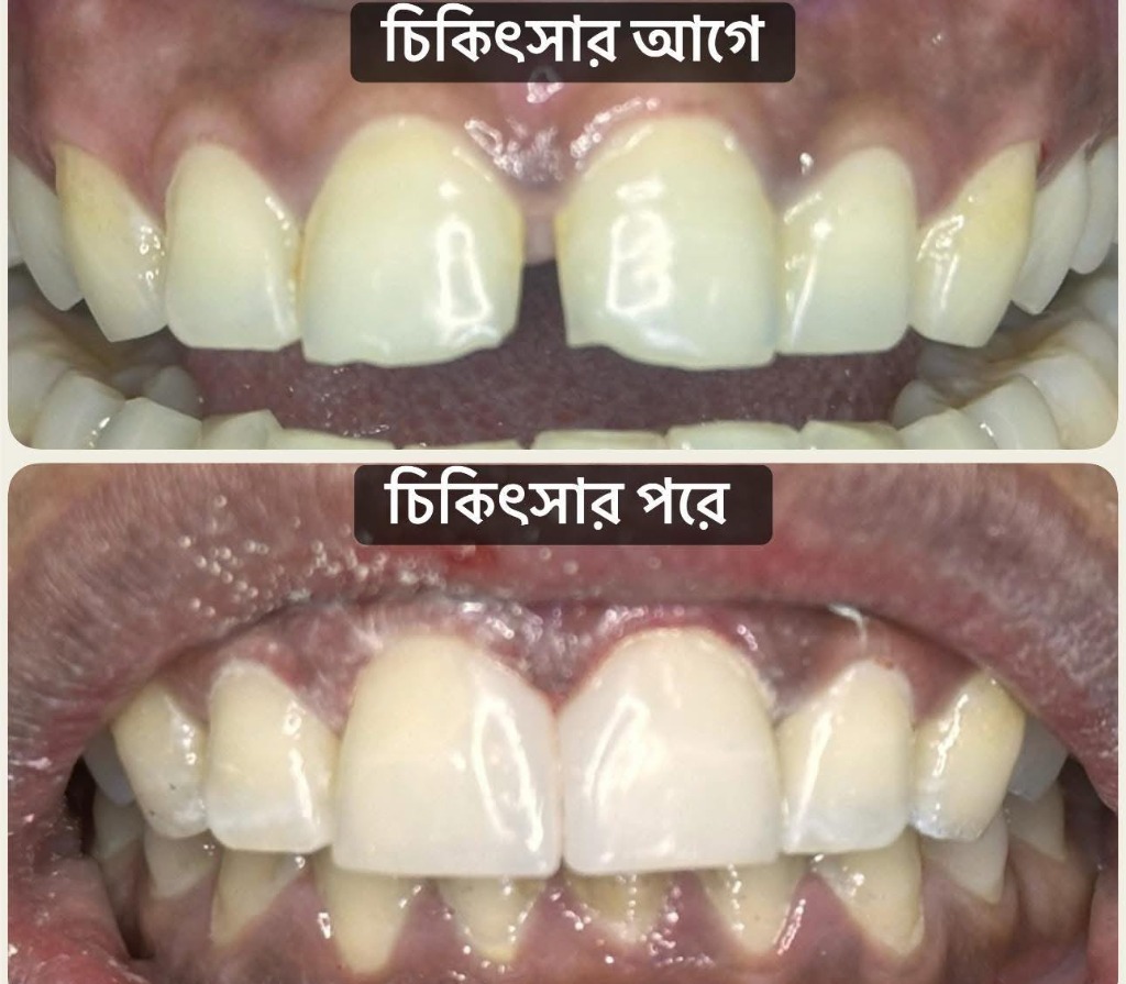 কম্পোজিট ভেনিয়ার কেস ৫ - ১ দিনে নিখুঁত ফাঁকা বন্ধ